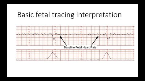 fetal heart rate tracing game.